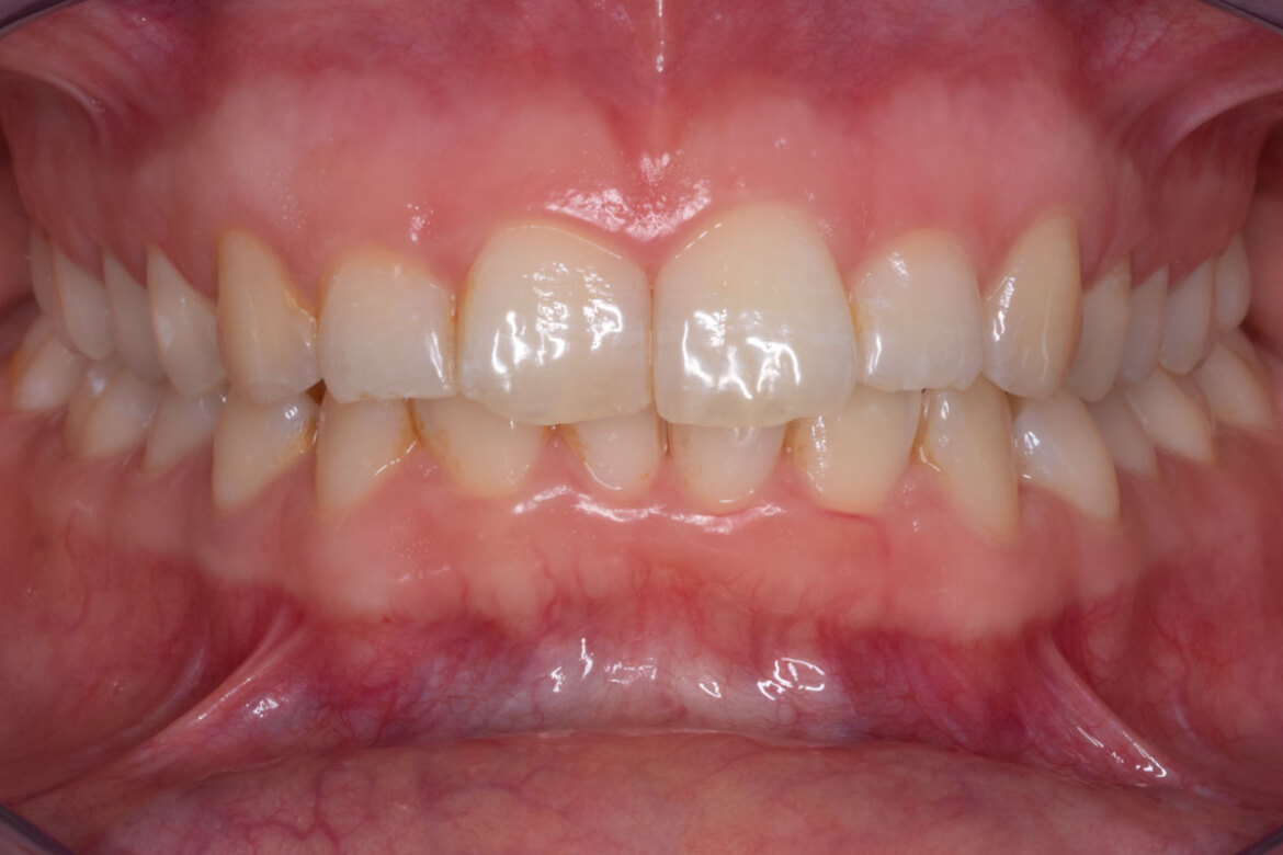 Nach dem Fotokurs dentale Fotografie ist das Foto vom Mundraum komplett ausgeleuchtet und durchgängig scharf, die Farben stimmen