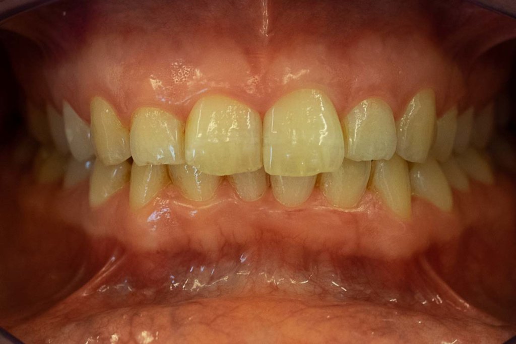 Foto vor dem dentalen Fotokurs mit Schatten, viel Unschärfe und falschen Farben